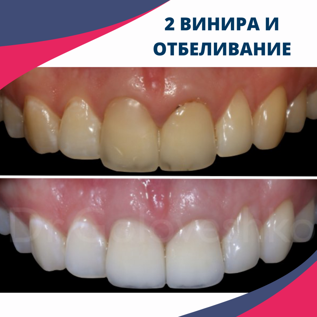 2 винира + отбеливание зубов в СПб
