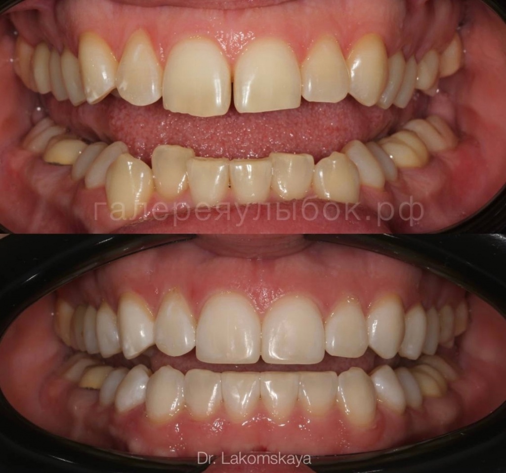 ортодонтическое лечение на элайнерах и отбеливание зубов в СПб