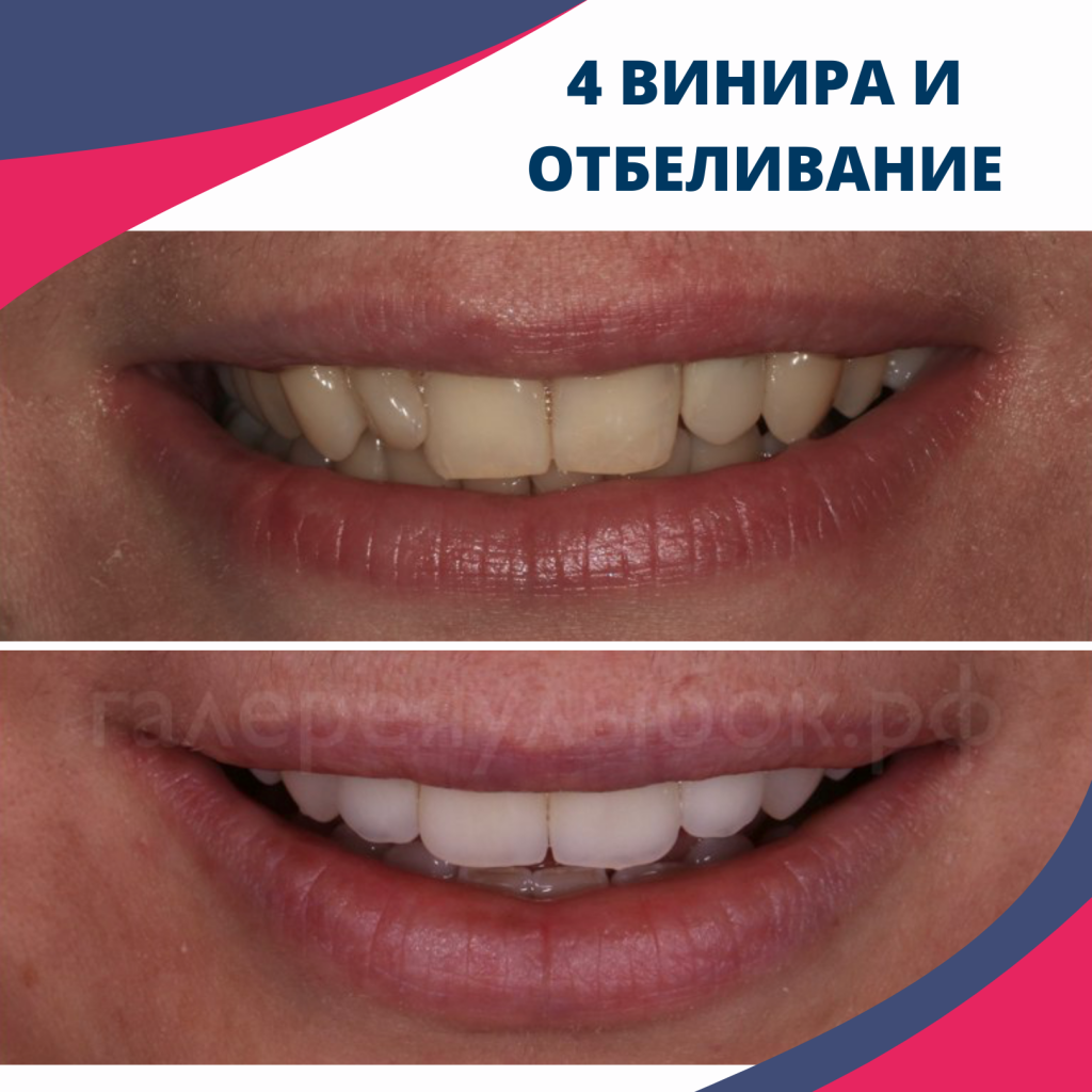 4 винира + отбеливание зубов в СПб