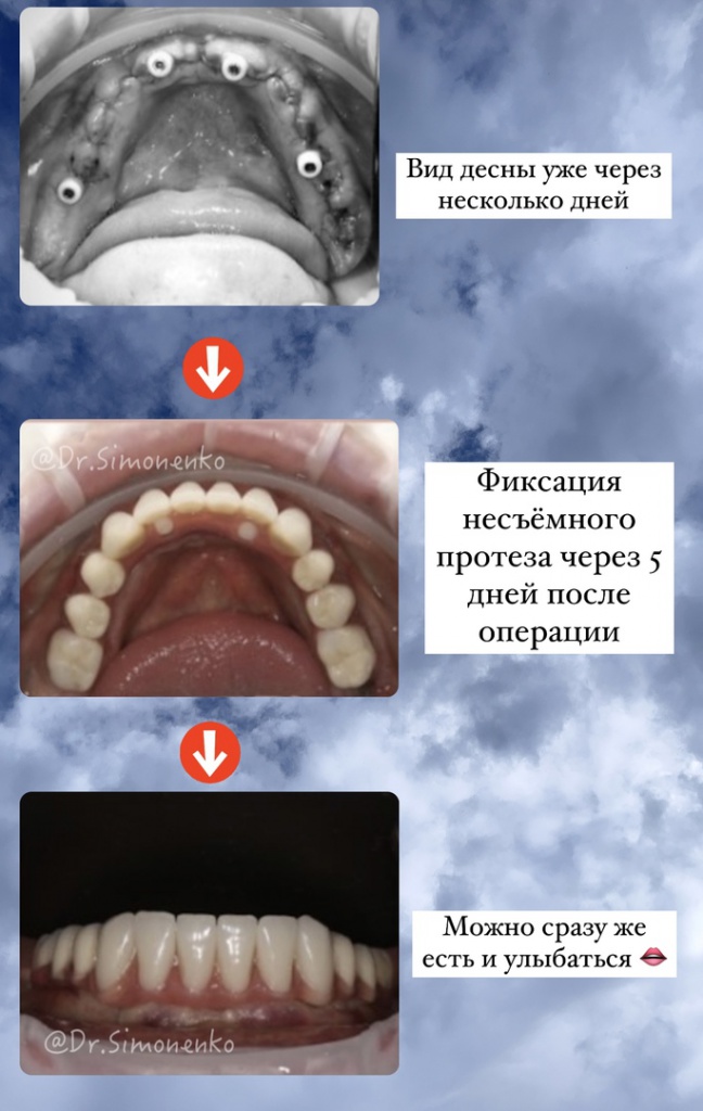 Удаление зубов и установка имплантов Все на 4