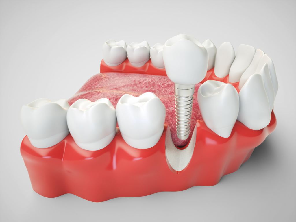 Возмещение костной ткани в стоматологии