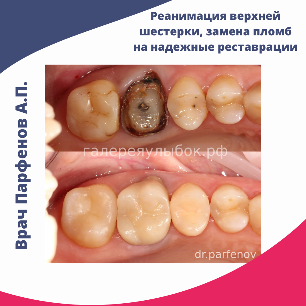 Зубная реанимация верхней шестерки