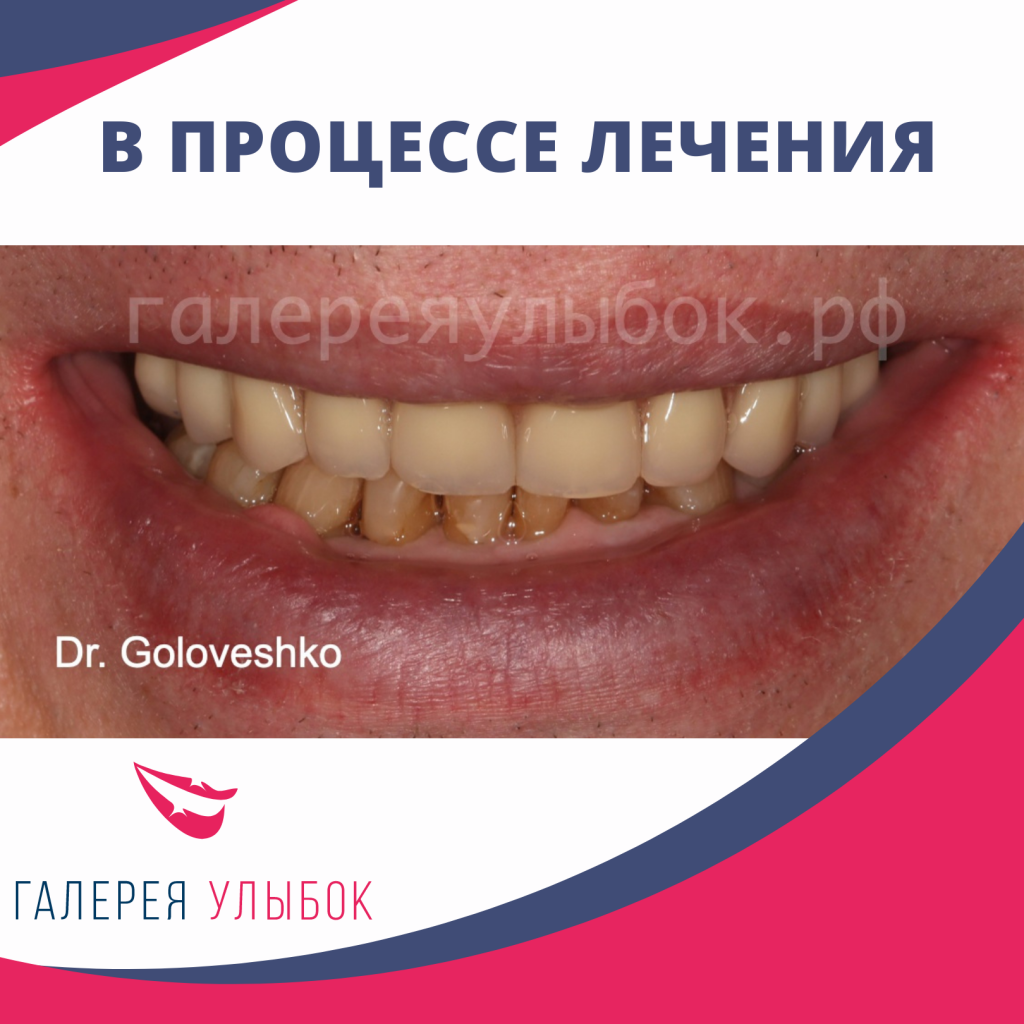 Отсутствие зубов и имплантация в СПб