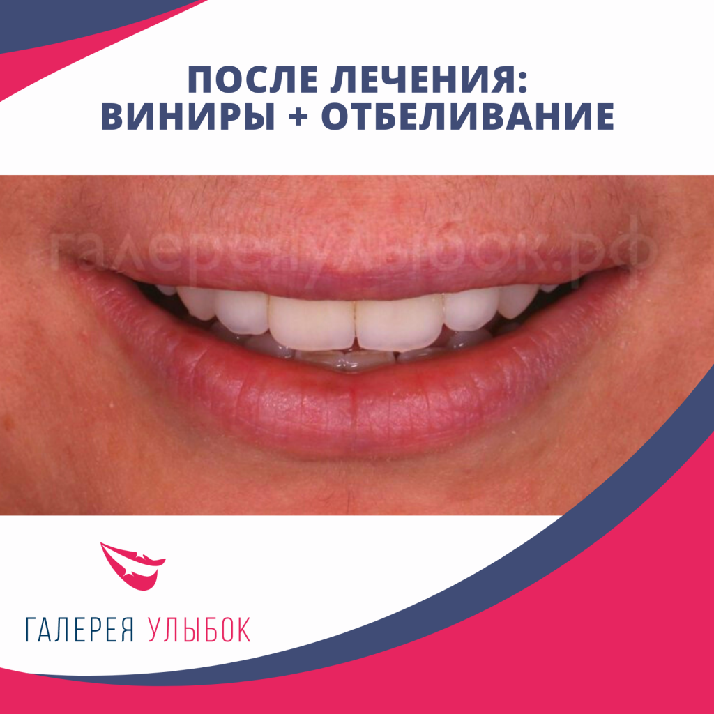 Керамические виниры + отбеливание зубов в СПб по акции