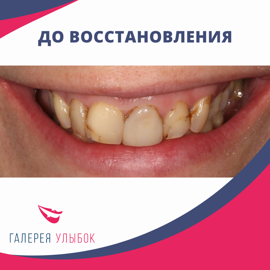 Восстановление зубов в СПб