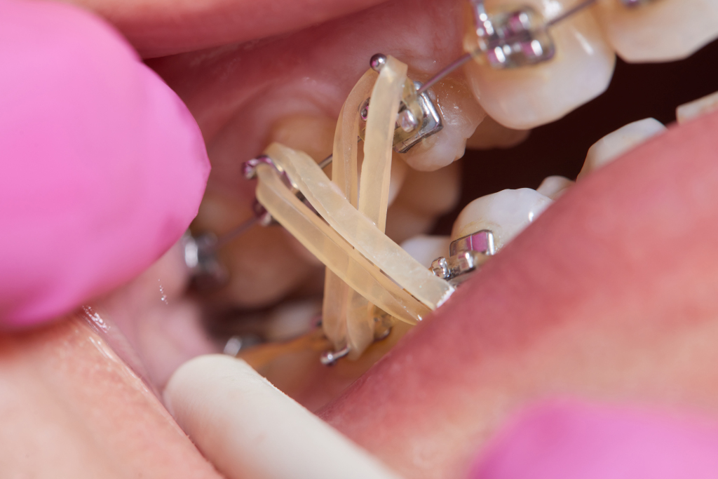 closeup-braces-teeth-with-elastics-orthodontic-treatment-front-view-dental-brackes.jpg