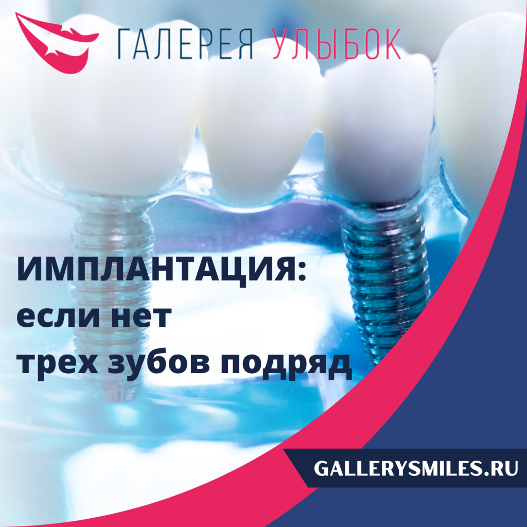 Имплантация на 3 зуба в СПб