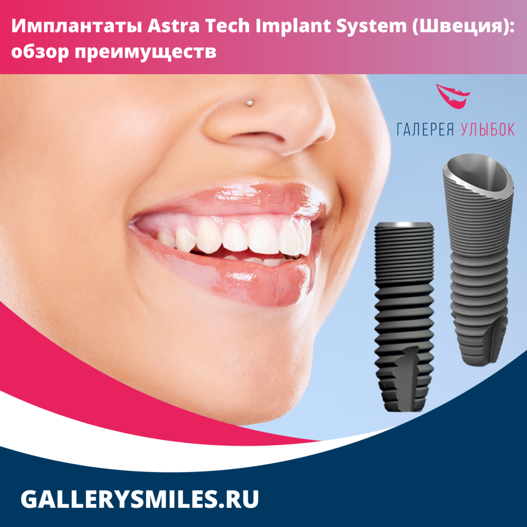 Имплантаты Astra Tech Implant System (Швеция): обзор преимуществ