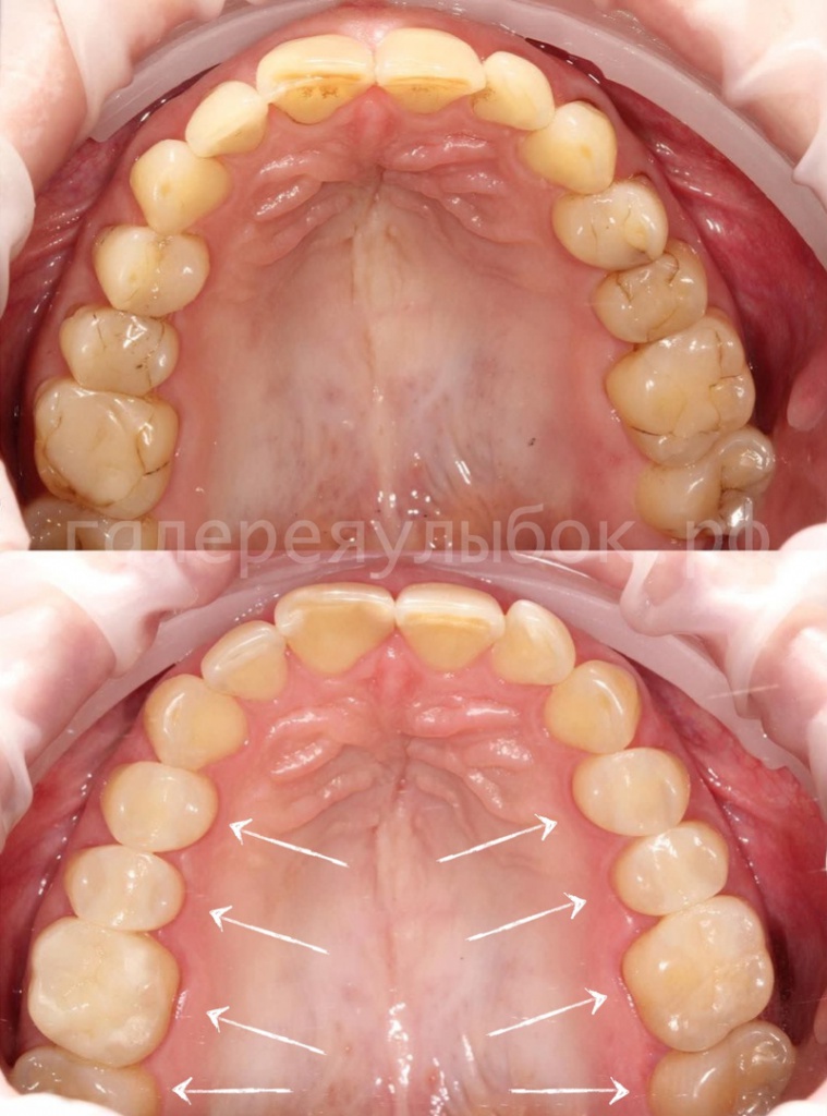 Пример профессиональной гигиены зубов из практики клиники "Галереи Улыбок"