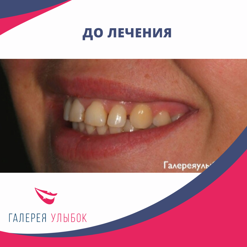 В таких случаях проводится ортодонтическое лечение, после чего окончательно корректируется форма виниров