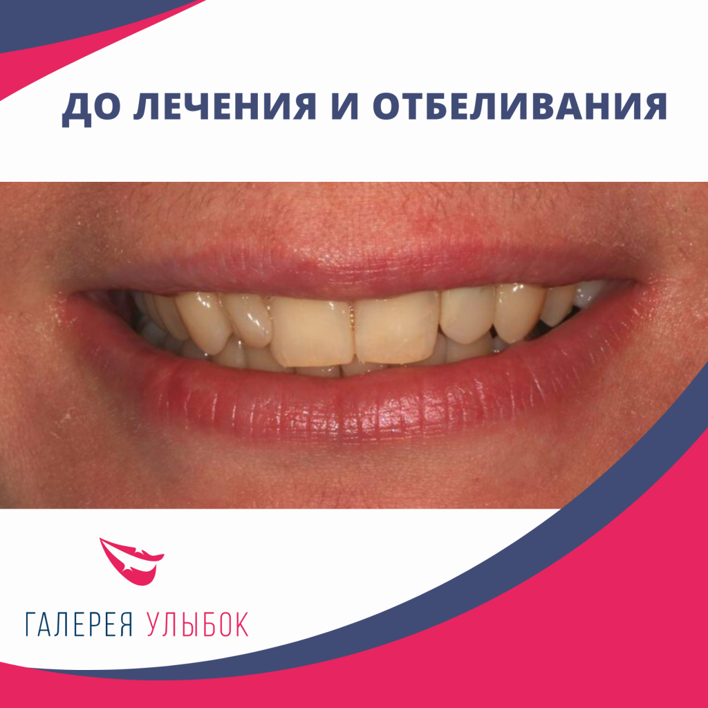 Керамические виниры + отбеливание зубов в СПб