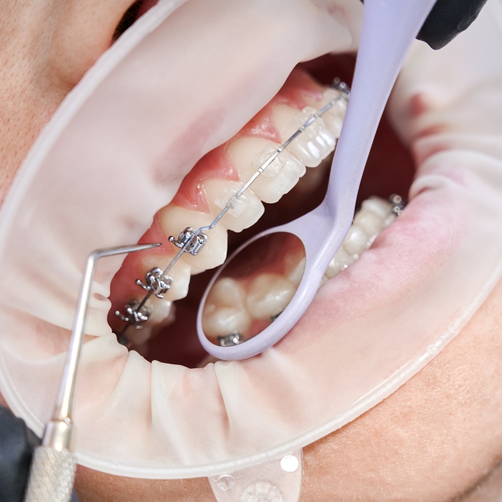 dentist-attaching-metal-braces-patient-teeth.jpg