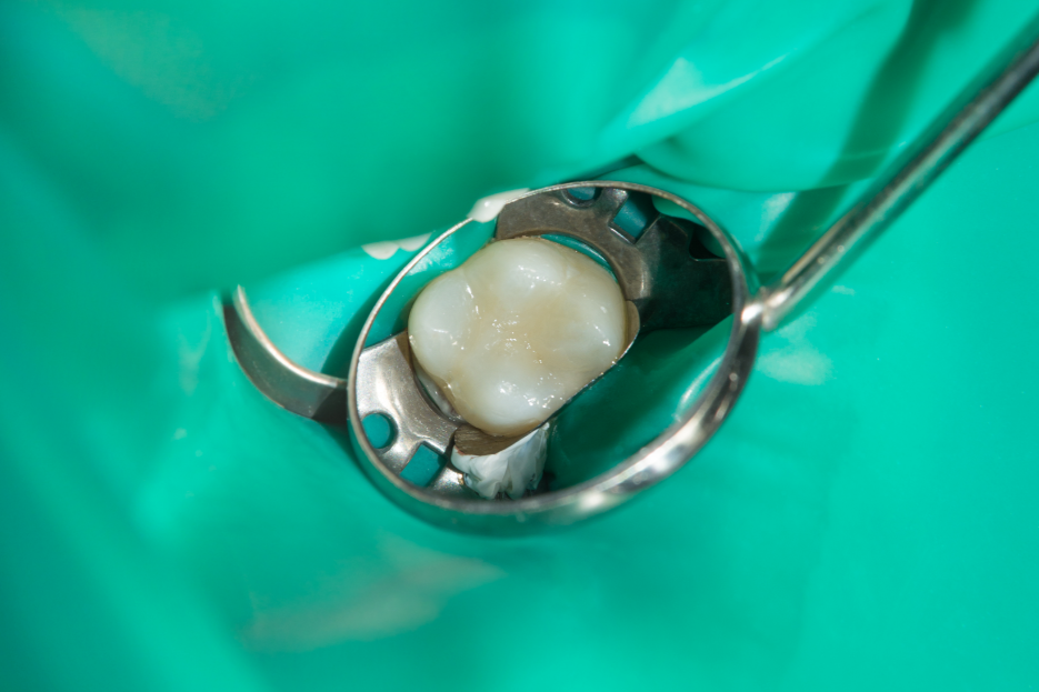 Лечение среднего кариеса зубов ведущий врач СПб