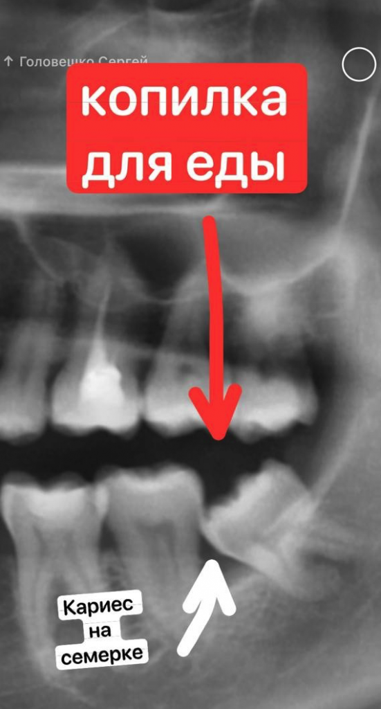 Безболезненное удаление зубов мудрости в СПб ведущим врачом