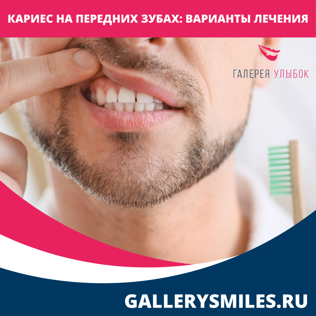 Лечение кариеса передних зубов - Стоматологическая клиника Галерея Улыбок Санкт-Петербург