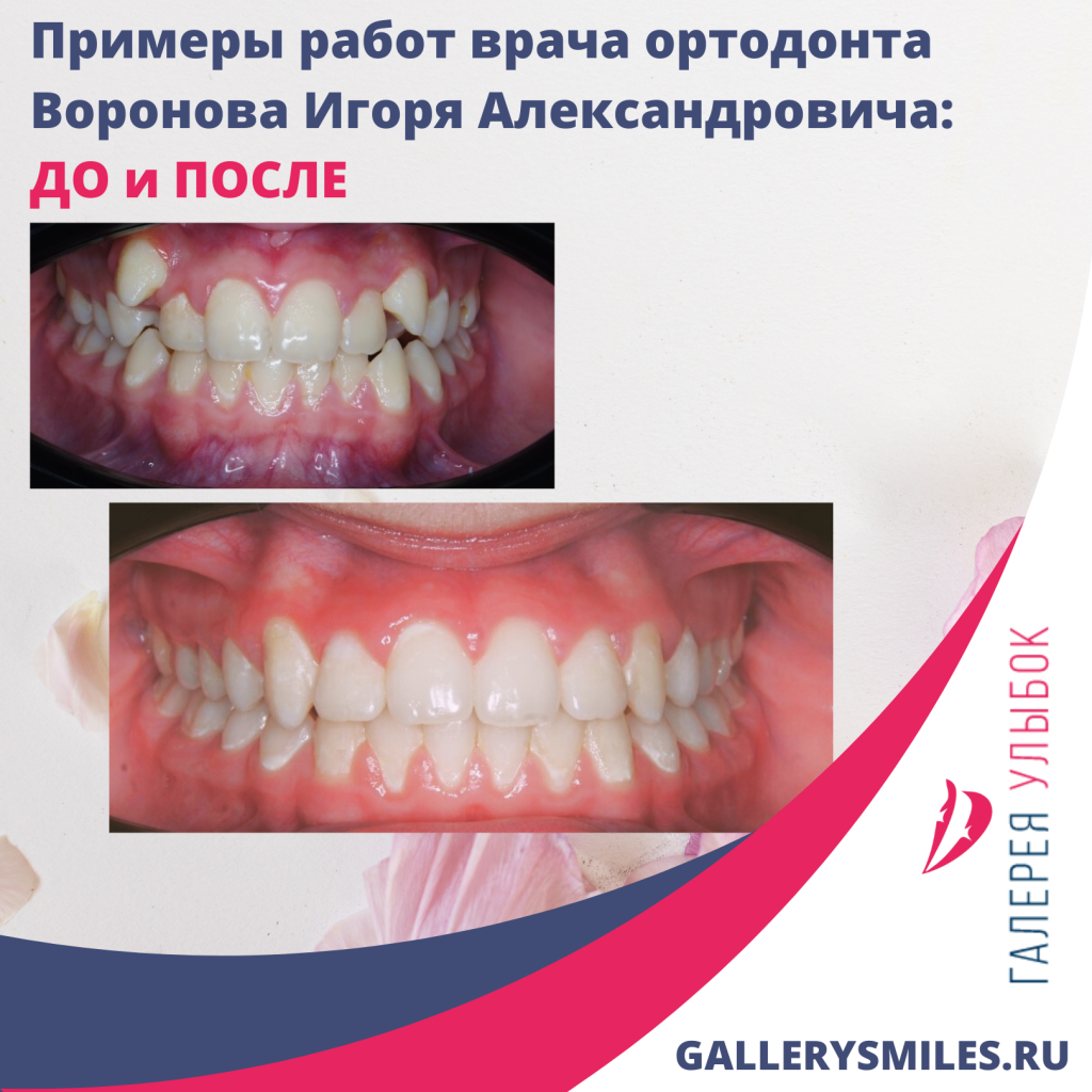 ortodontiya-galereya-ulybok4.png