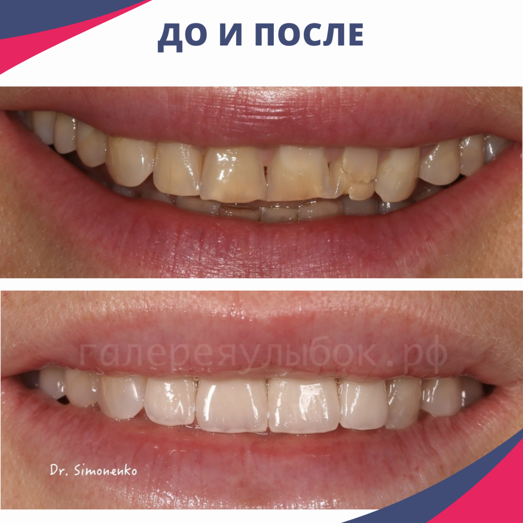 Керамические виниры и отбеливание зубов пример 2