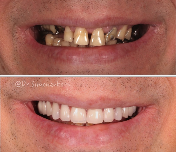 Удаление зубов перед имплантацией СПб