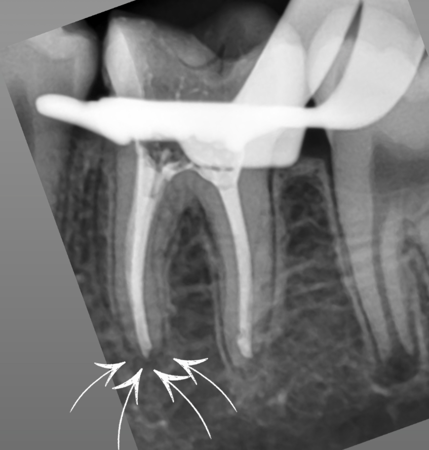 Лечение каналов зуба под микроскопом