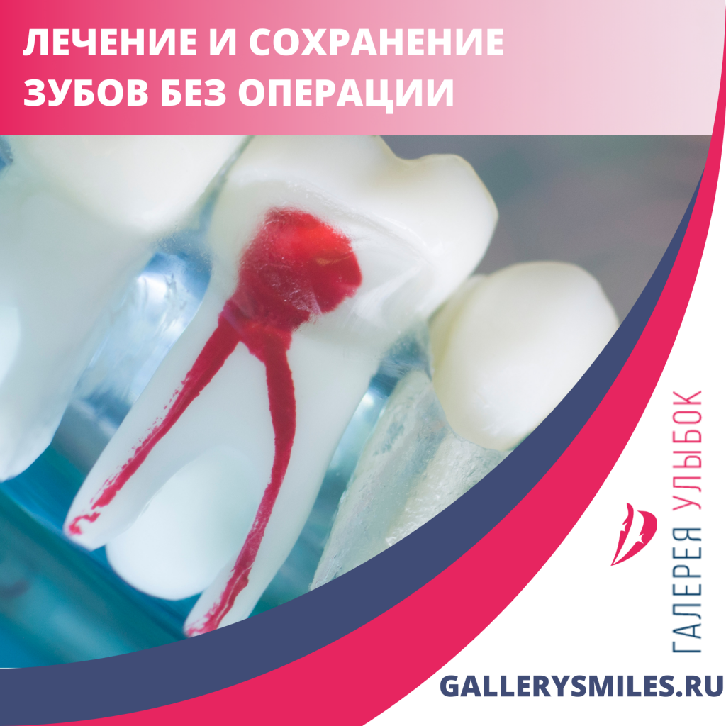 Лечение зубов без операции в Санкт-Петербурге