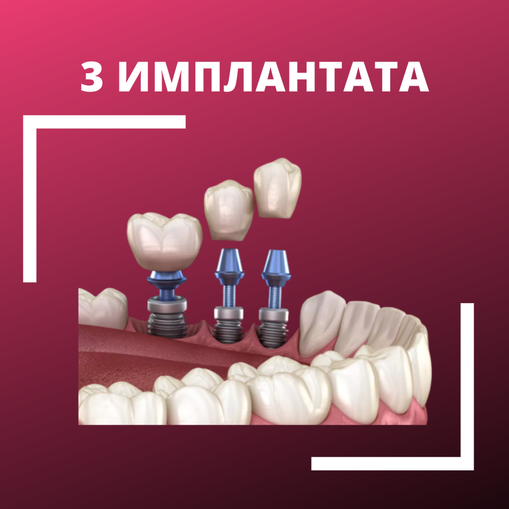 Установка имплантов на три зуба в СПб