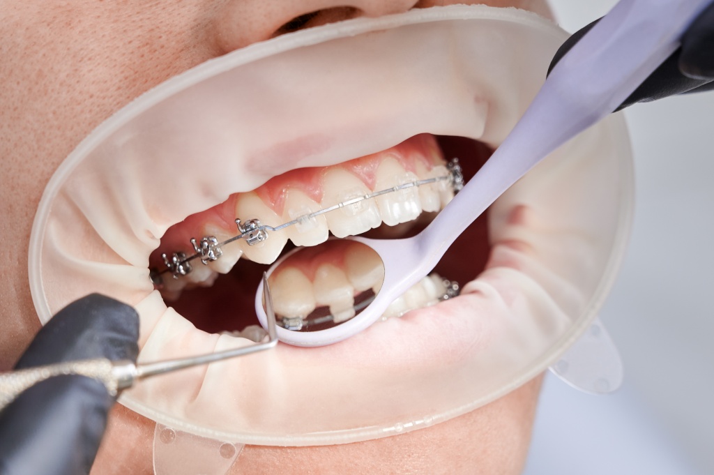 dentist-attaching-metal-braces-patient-teeth.jpg