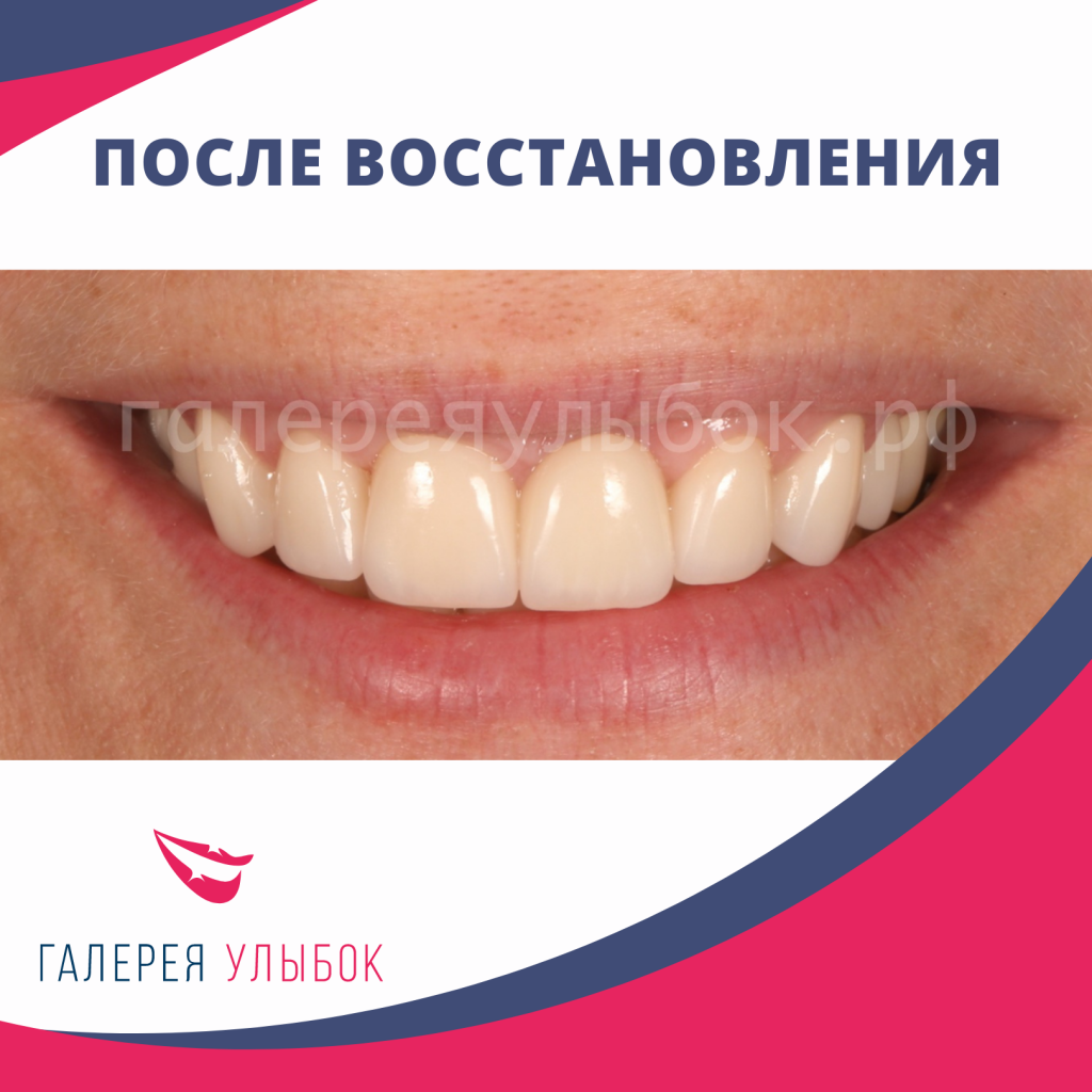 Результат восстановления зубов СПб