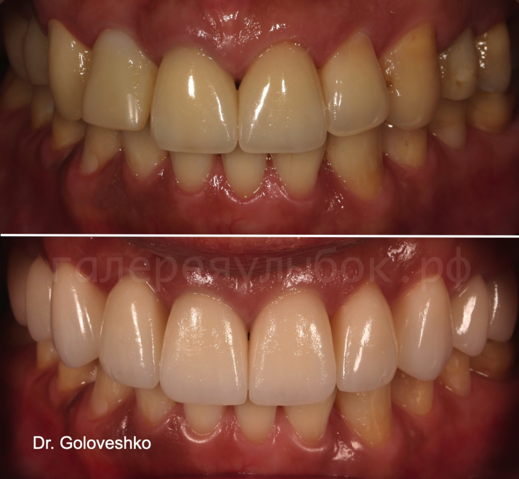 Пример имплантации в комплексном лечении зубов