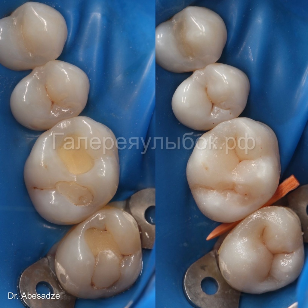 Пример лечения кариеса из практики Стоматологической клиники "Галерея Улыбок" в Мурино