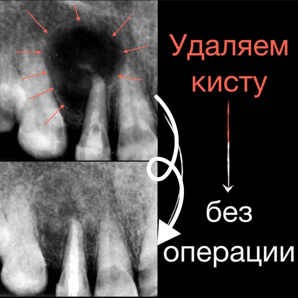 Лечение кисты зуба без операции в СПб