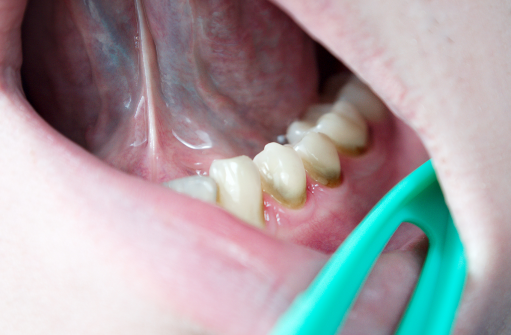 Причины пародонтита мнение стоматолога