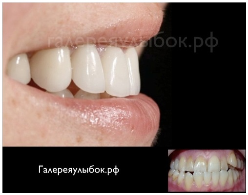 Ортодонтическое лечение и восстановление зубов винирами