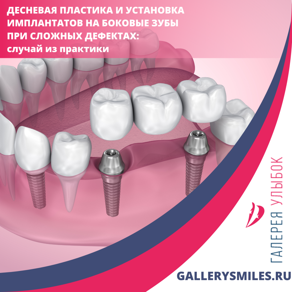 Десневая пластика и установка имплантатов на боковые зубы в СПб