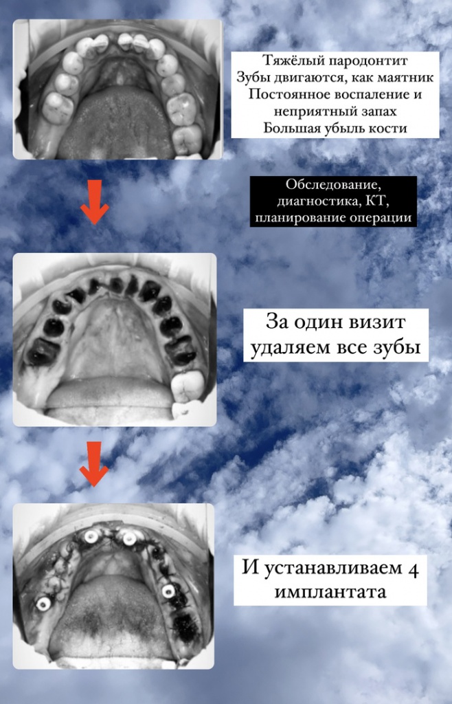 Удаление зубов и установка несъемных протезов СПб